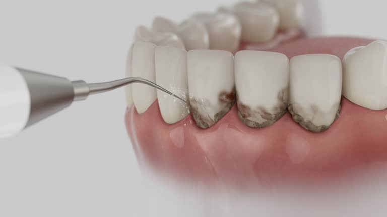 Trusted Wisdom Tooth Removal service in Summitville, IN - Dentist Open Now